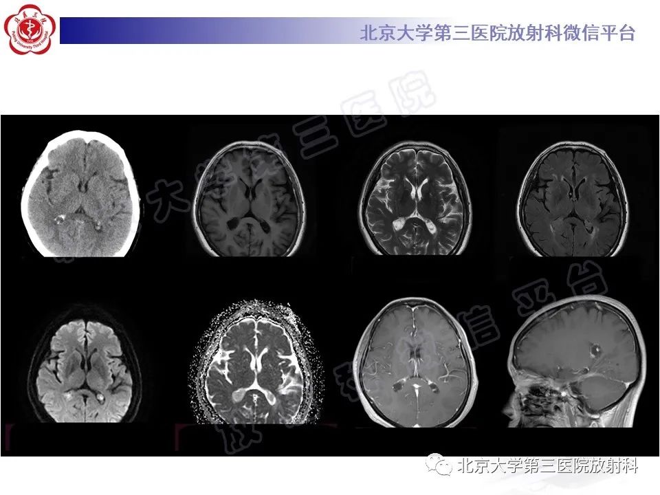影像PPT - 【PPT】脉络丛黄色肉芽肿-3