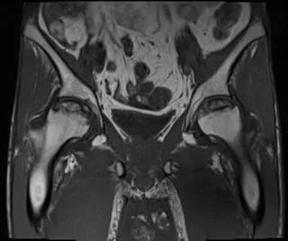 影像PPT - 【病例】股骨头缺血性坏死1例X线MR-4 影像PPT - 【病例】股骨头缺血性坏死1例X线MR-4