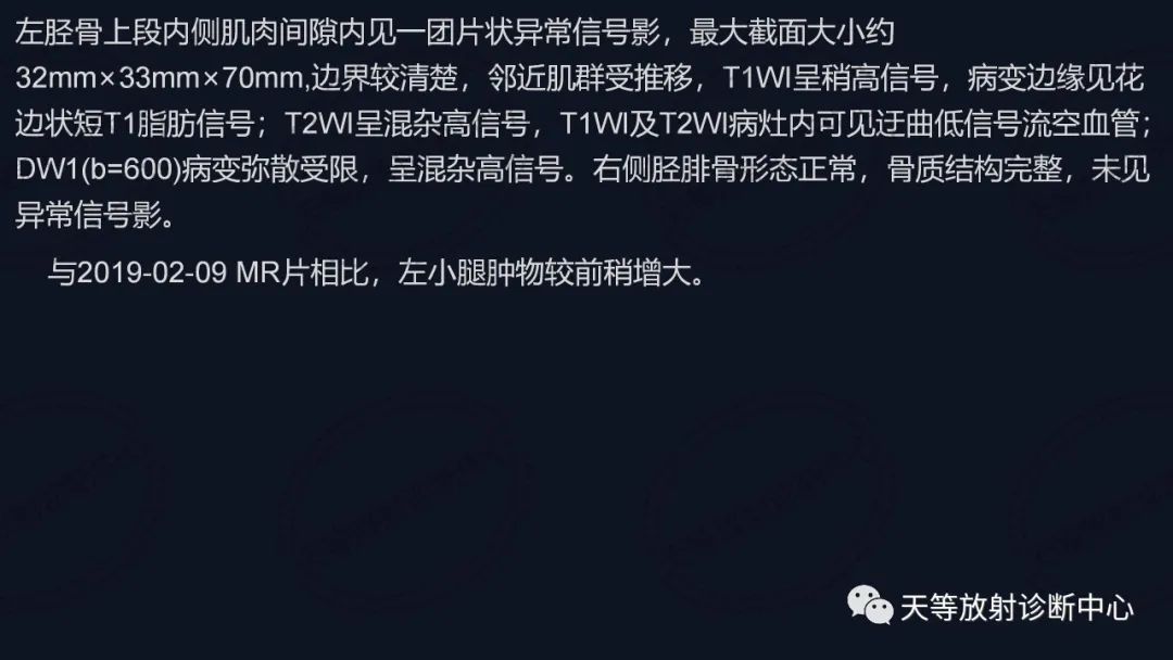 影像PPT - 【病例】软组织血管瘤1例MR-14 影像PPT - 【病例】软组织血管瘤1例MR-14
