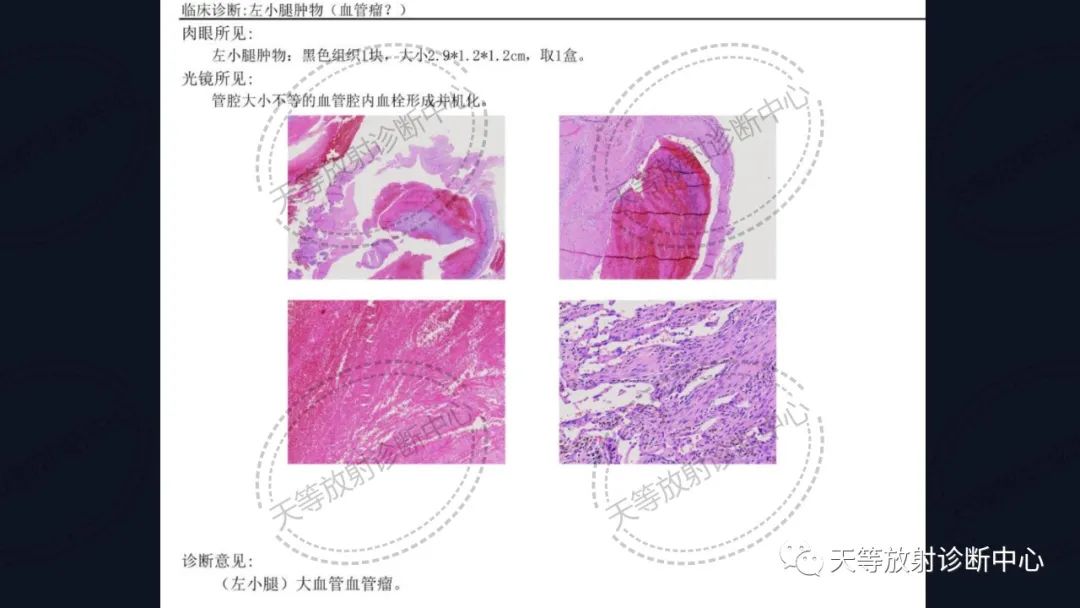 影像PPT - 【病例】软组织血管瘤1例MR-16 影像PPT - 【病例】软组织血管瘤1例MR-16