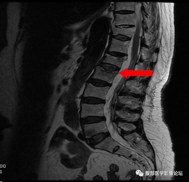 影像PPT - 【病例】一例压缩性骨折所引起的思考-5 影像PPT - 【病例】一例压缩性骨折所引起的思考-5