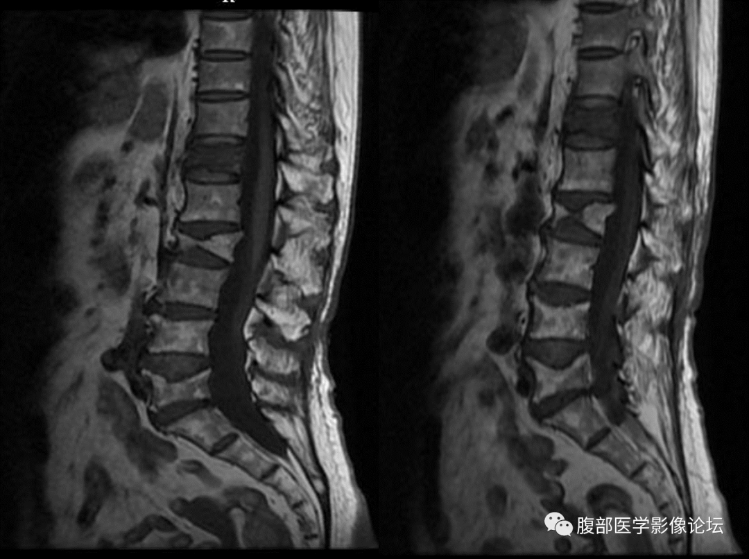 影像PPT - 【病例】一例压缩性骨折所引起的思考-3 影像PPT - 【病例】一例压缩性骨折所引起的思考-3