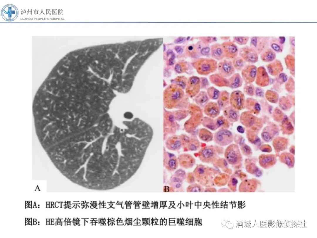 影像PPT - 【PPT】吸烟相关间质性肺疾病影像表现-4