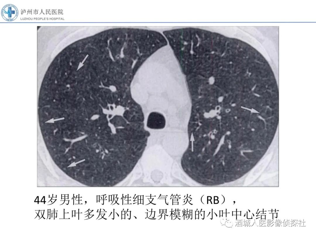 影像PPT - 【PPT】吸烟相关间质性肺疾病影像表现-5