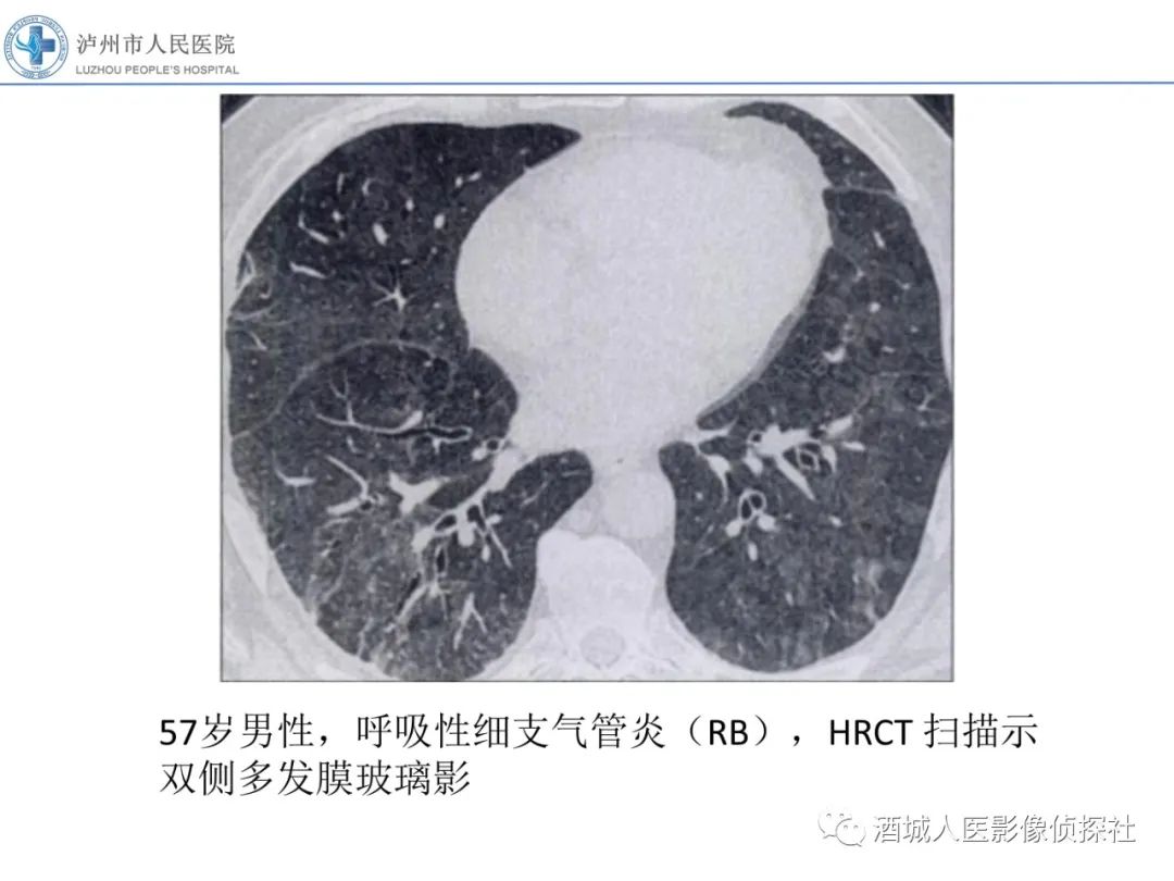 影像PPT - 【PPT】吸烟相关间质性肺疾病影像表现-6