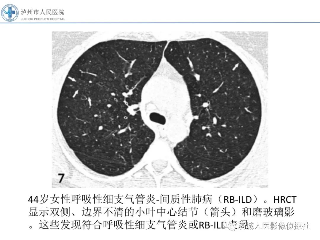影像PPT - 【PPT】吸烟相关间质性肺疾病影像表现-8