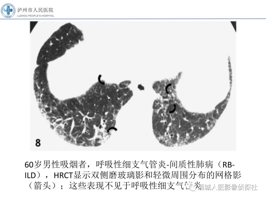 影像PPT - 【PPT】吸烟相关间质性肺疾病影像表现-9