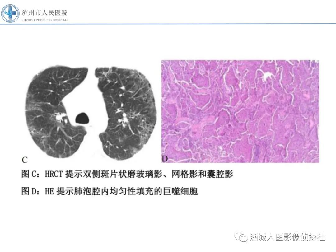 影像PPT - 【PPT】吸烟相关间质性肺疾病影像表现-13