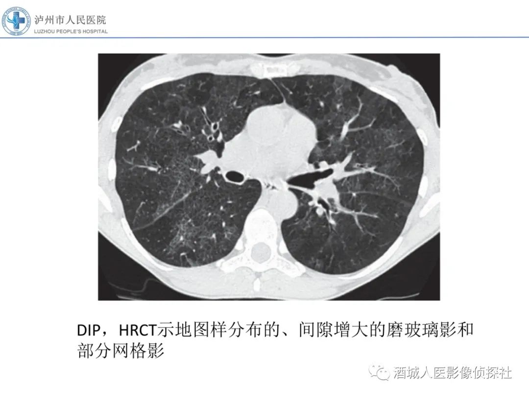 影像PPT - 【PPT】吸烟相关间质性肺疾病影像表现-15
