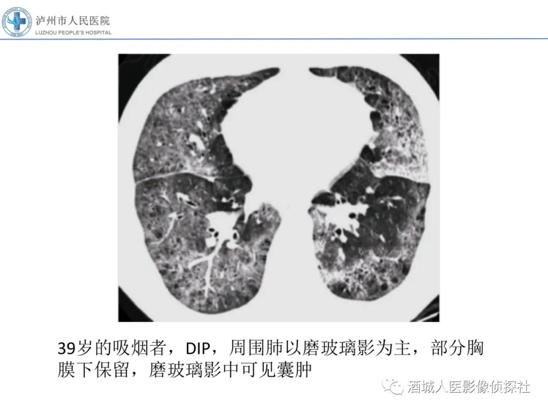 影像PPT - 【PPT】吸烟相关间质性肺疾病影像表现-16
