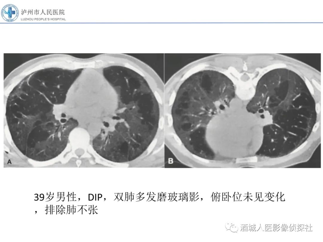 影像PPT - 【PPT】吸烟相关间质性肺疾病影像表现-17