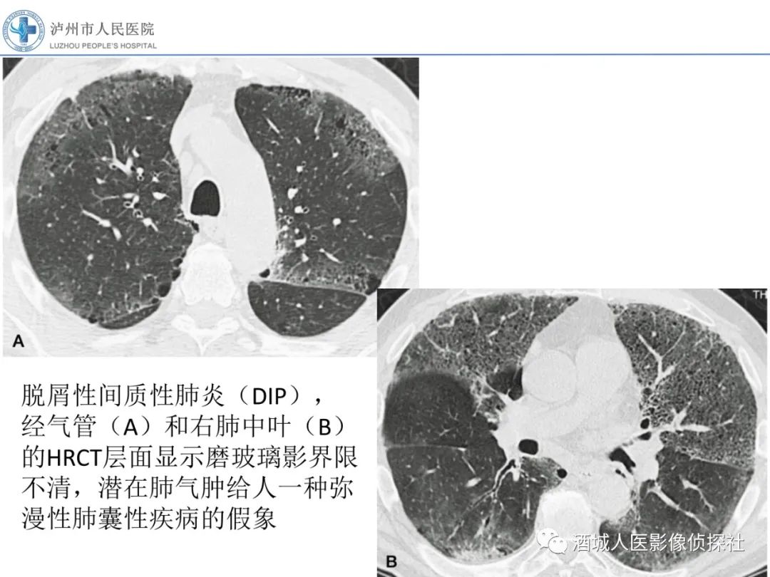 影像PPT - 【PPT】吸烟相关间质性肺疾病影像表现-14