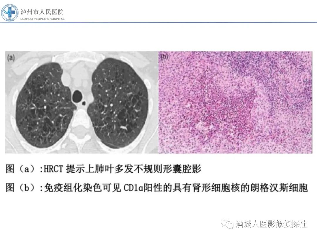 影像PPT - 【PPT】吸烟相关间质性肺疾病影像表现-21