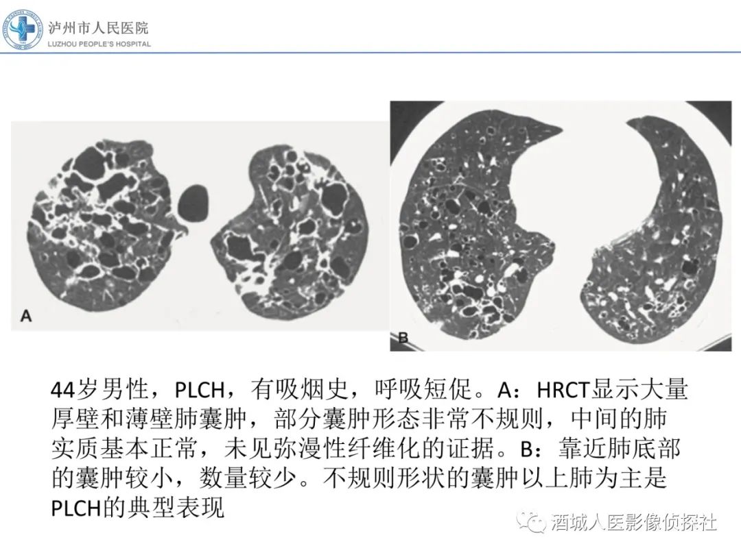影像PPT - 【PPT】吸烟相关间质性肺疾病影像表现-22