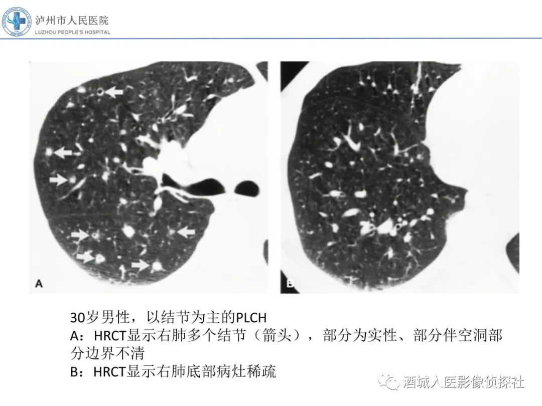 影像PPT - 【PPT】吸烟相关间质性肺疾病影像表现-23