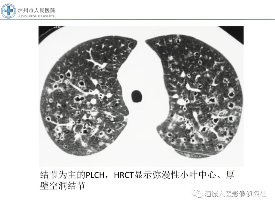 影像PPT - 【PPT】吸烟相关间质性肺疾病影像表现-24
