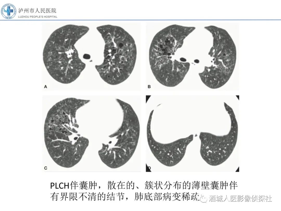 影像PPT - 【PPT】吸烟相关间质性肺疾病影像表现-25