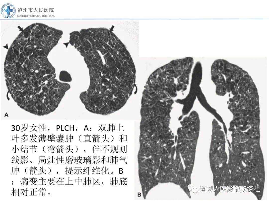 影像PPT - 【PPT】吸烟相关间质性肺疾病影像表现-27