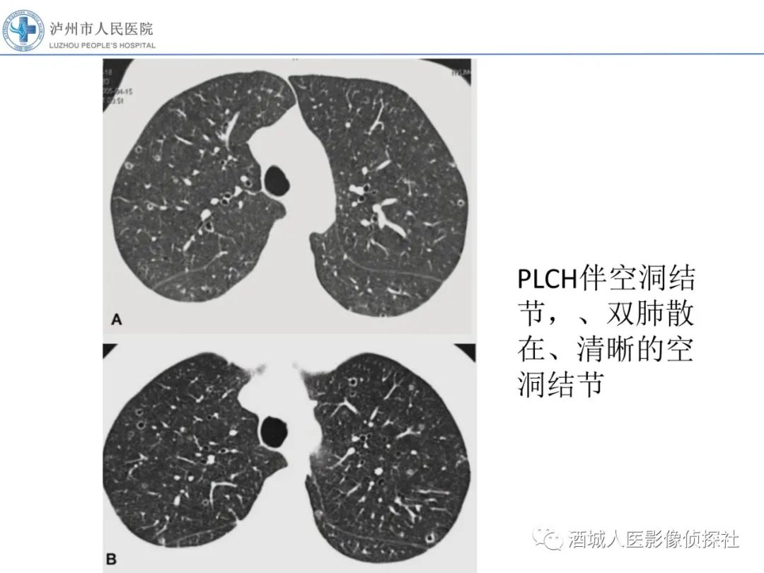 影像PPT - 【PPT】吸烟相关间质性肺疾病影像表现-26