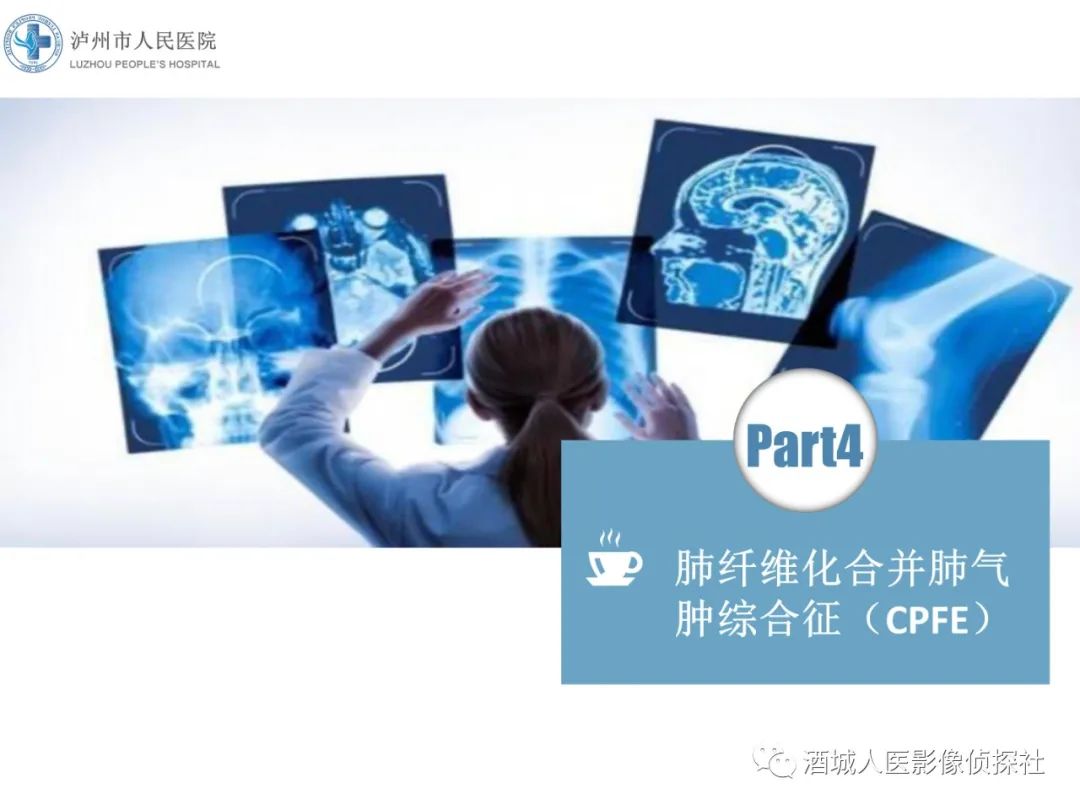 影像PPT - 【PPT】吸烟相关间质性肺疾病影像表现-29