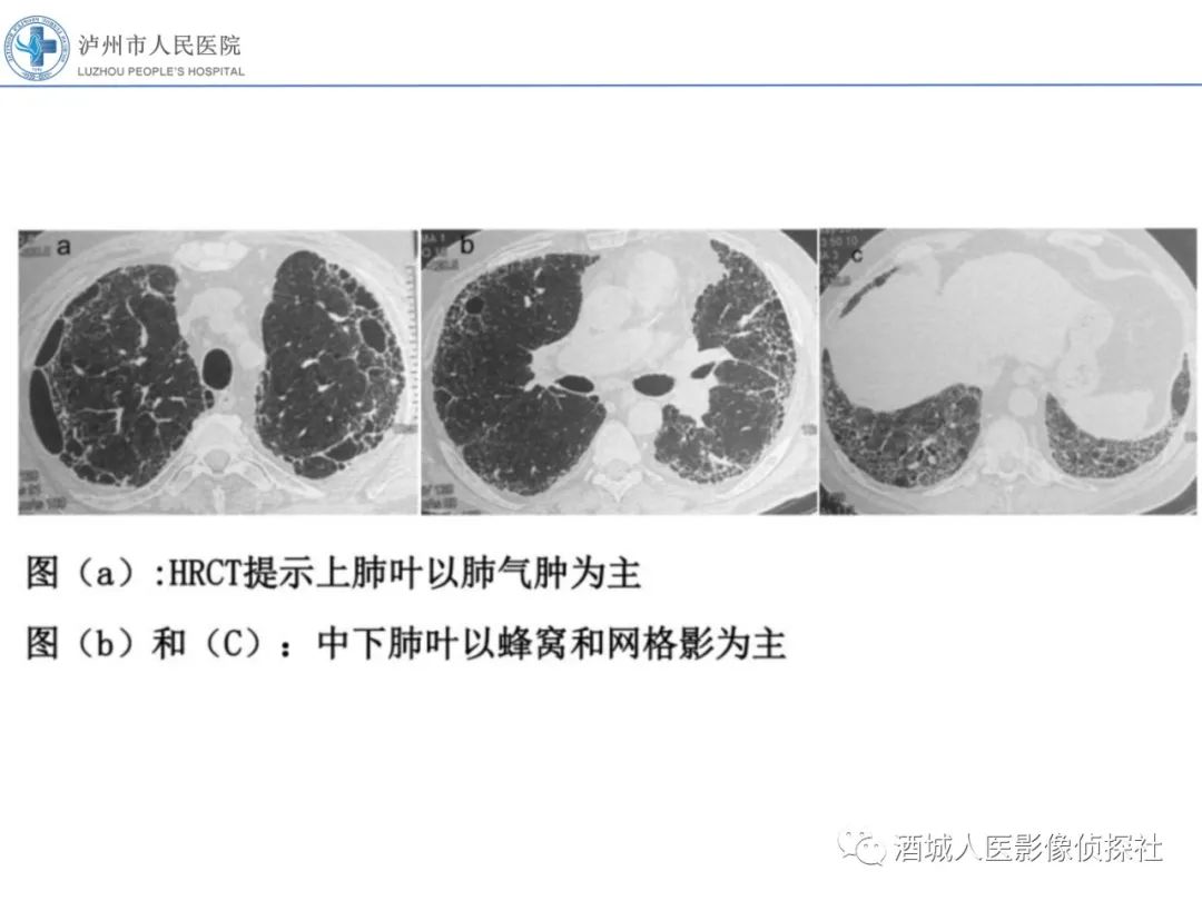 影像PPT - 【PPT】吸烟相关间质性肺疾病影像表现-33