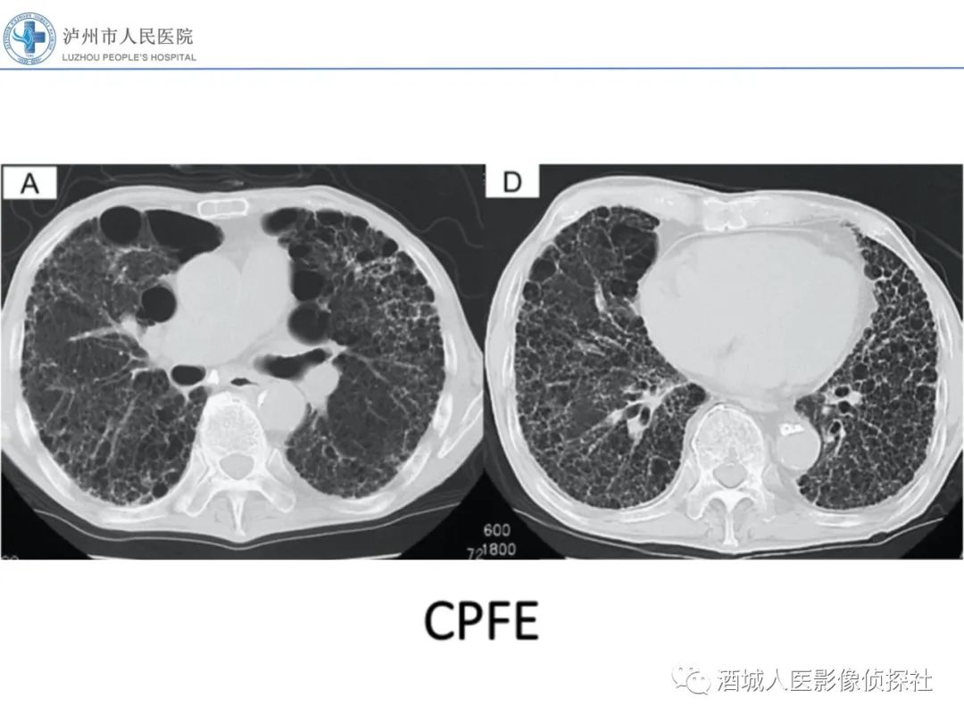 影像PPT - 【PPT】吸烟相关间质性肺疾病影像表现-34