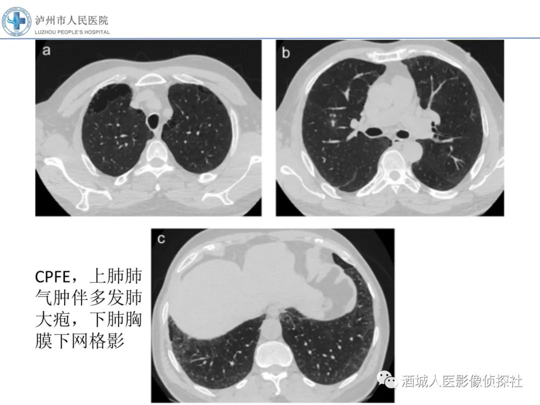 影像PPT - 【PPT】吸烟相关间质性肺疾病影像表现-35