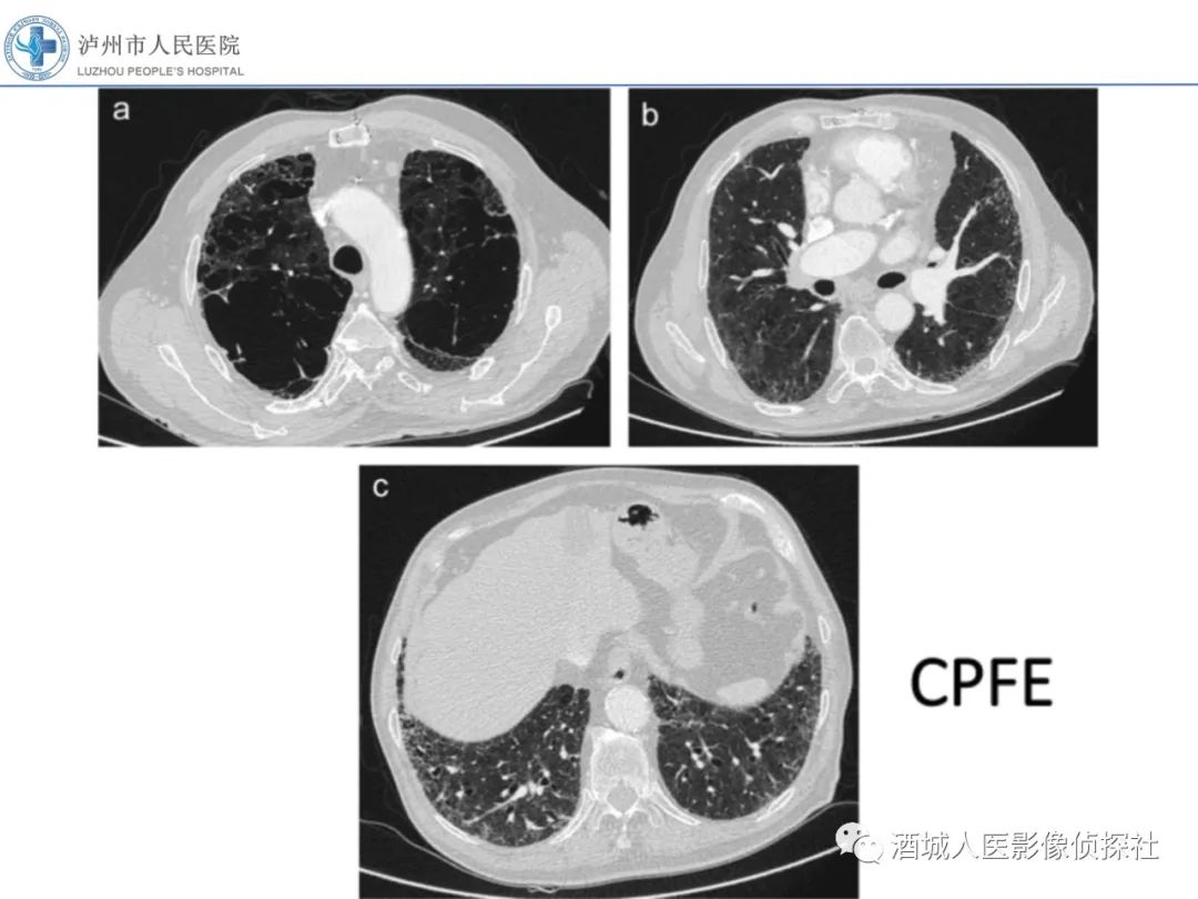 影像PPT - 【PPT】吸烟相关间质性肺疾病影像表现-36