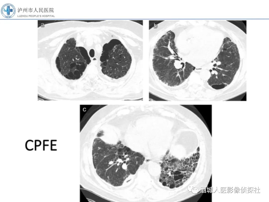 影像PPT - 【PPT】吸烟相关间质性肺疾病影像表现-37