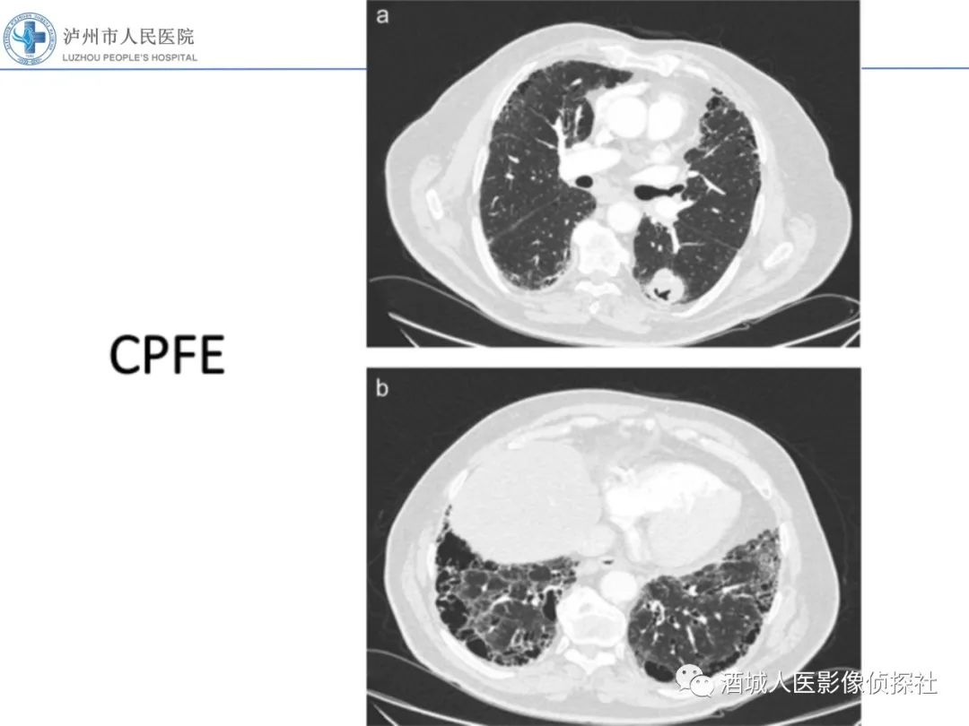 影像PPT - 【PPT】吸烟相关间质性肺疾病影像表现-39