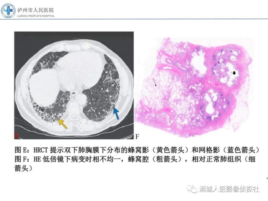影像PPT - 【PPT】吸烟相关间质性肺疾病影像表现-43