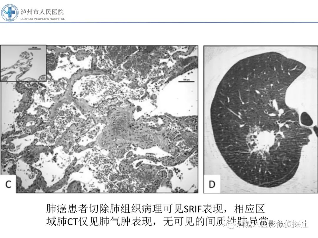 影像PPT - 【PPT】吸烟相关间质性肺疾病影像表现-47