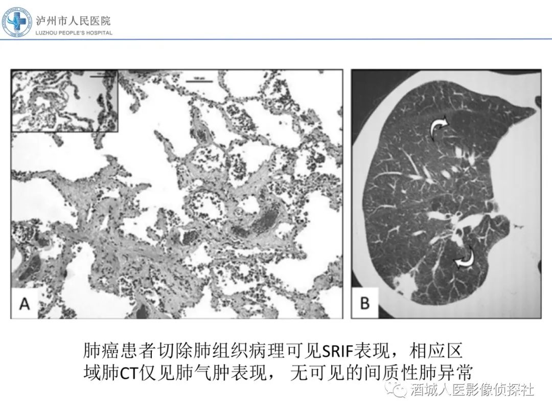 影像PPT - 【PPT】吸烟相关间质性肺疾病影像表现-1