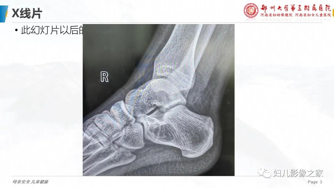 影像PPT - 【PPT】骨囊肿的鉴别诊断-3