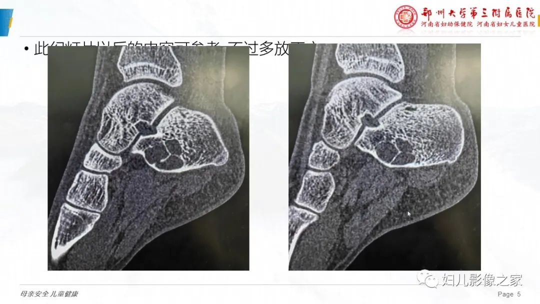 影像PPT - 【PPT】骨囊肿的鉴别诊断-5