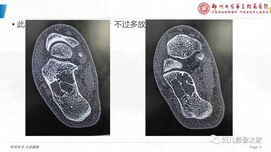 影像PPT - 【PPT】骨囊肿的鉴别诊断-6