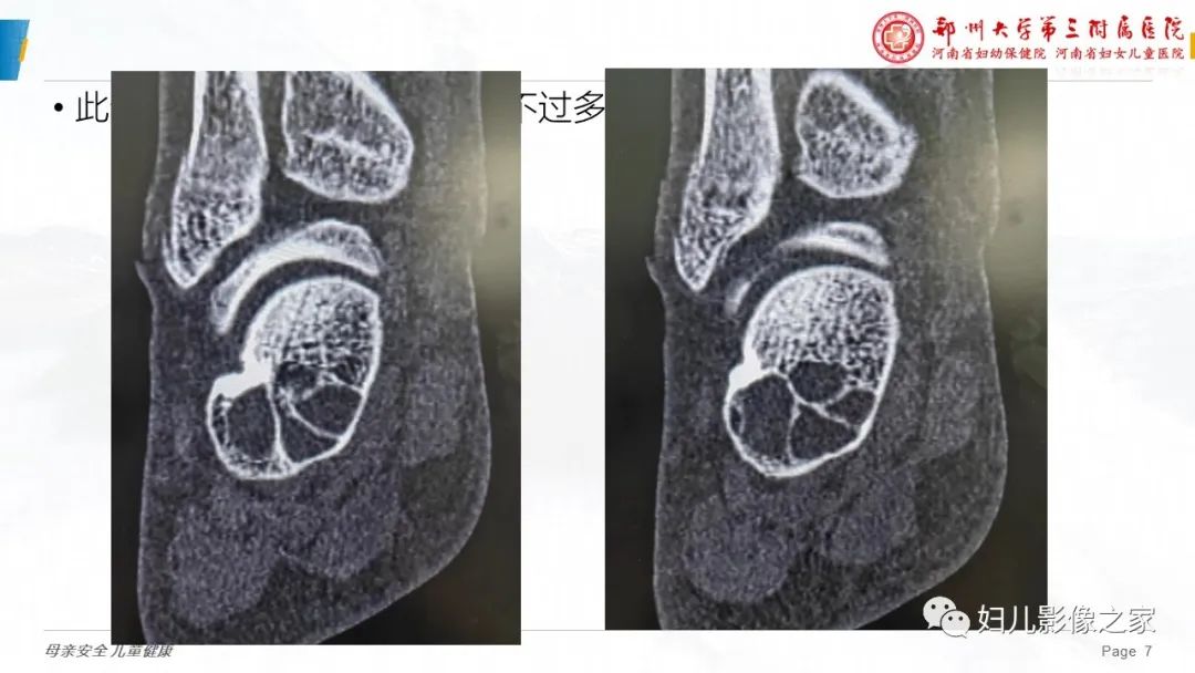 影像PPT - 【PPT】骨囊肿的鉴别诊断-7