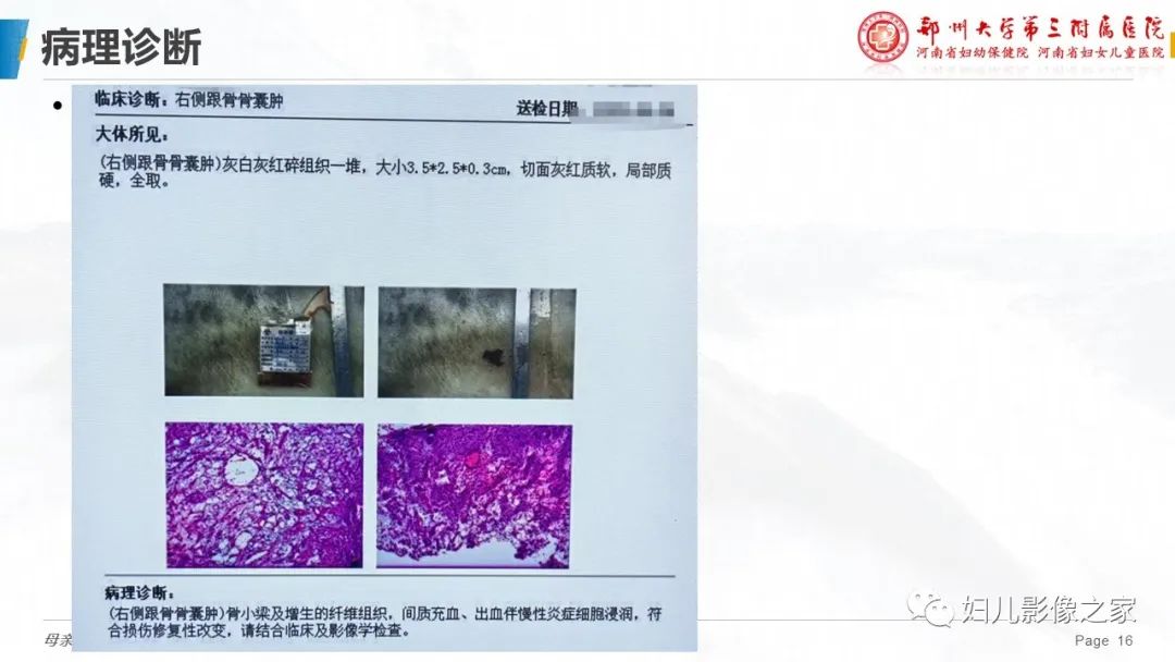 影像PPT - 【PPT】骨囊肿的鉴别诊断-16