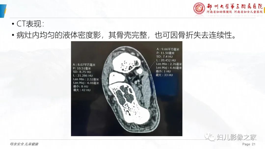 影像PPT - 【PPT】骨囊肿的鉴别诊断-21