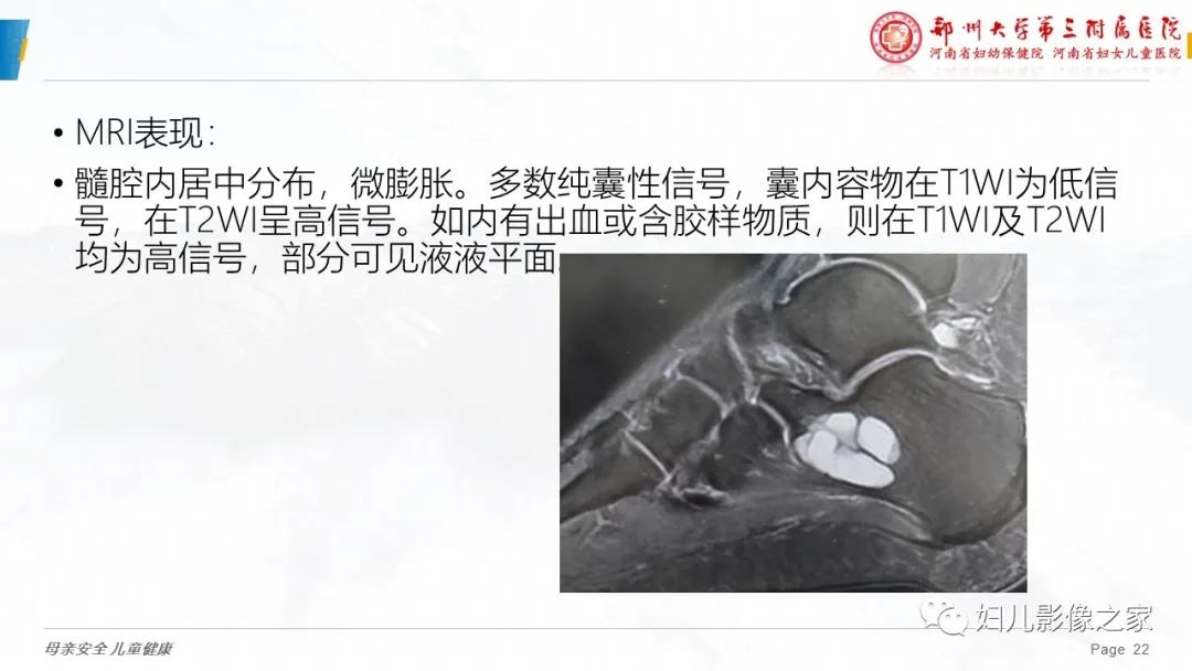 影像PPT - 【PPT】骨囊肿的鉴别诊断-22