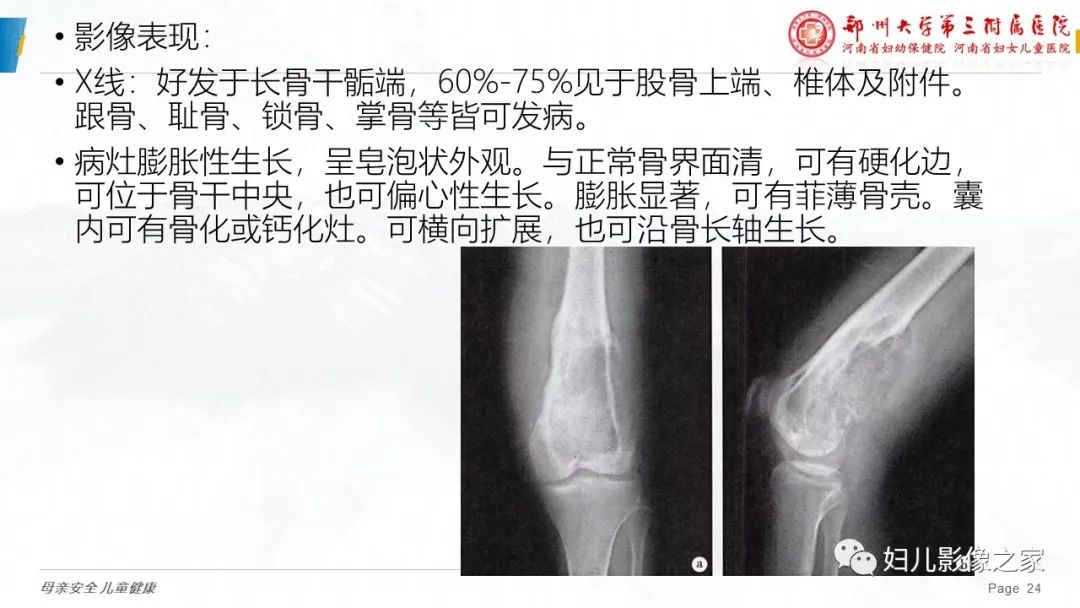 影像PPT - 【PPT】骨囊肿的鉴别诊断-24