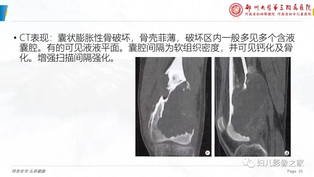 影像PPT - 【PPT】骨囊肿的鉴别诊断-25