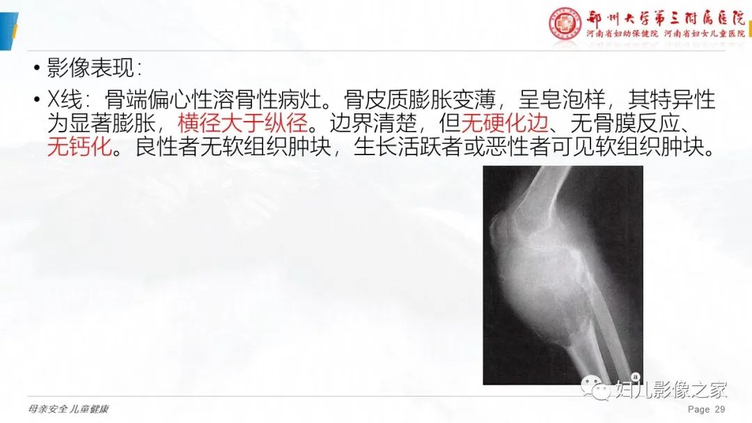影像PPT - 【PPT】骨囊肿的鉴别诊断-29