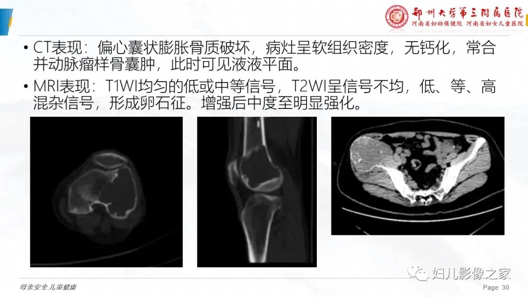 影像PPT - 【PPT】骨囊肿的鉴别诊断-30