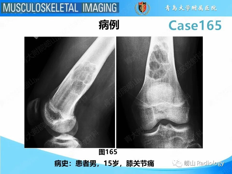 影像PPT - 【PPT】非骨化性纤维瘤-2