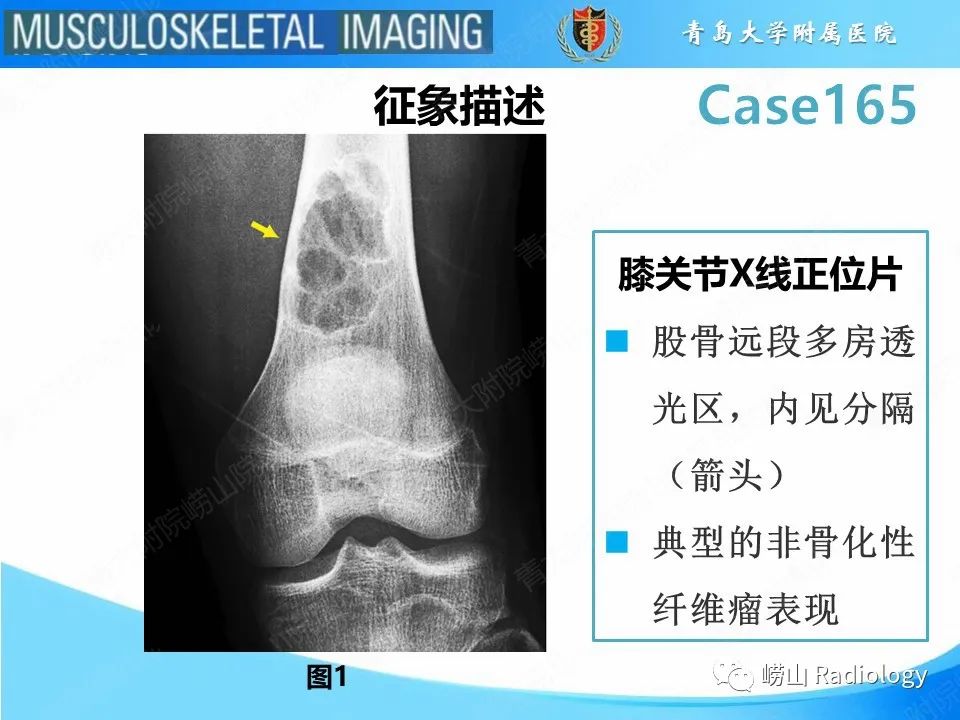 影像PPT - 【PPT】非骨化性纤维瘤-7
