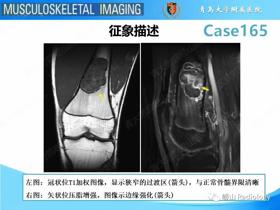 影像PPT - 【PPT】非骨化性纤维瘤-9