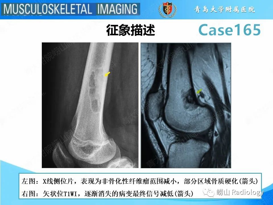 影像PPT - 【PPT】非骨化性纤维瘤-10