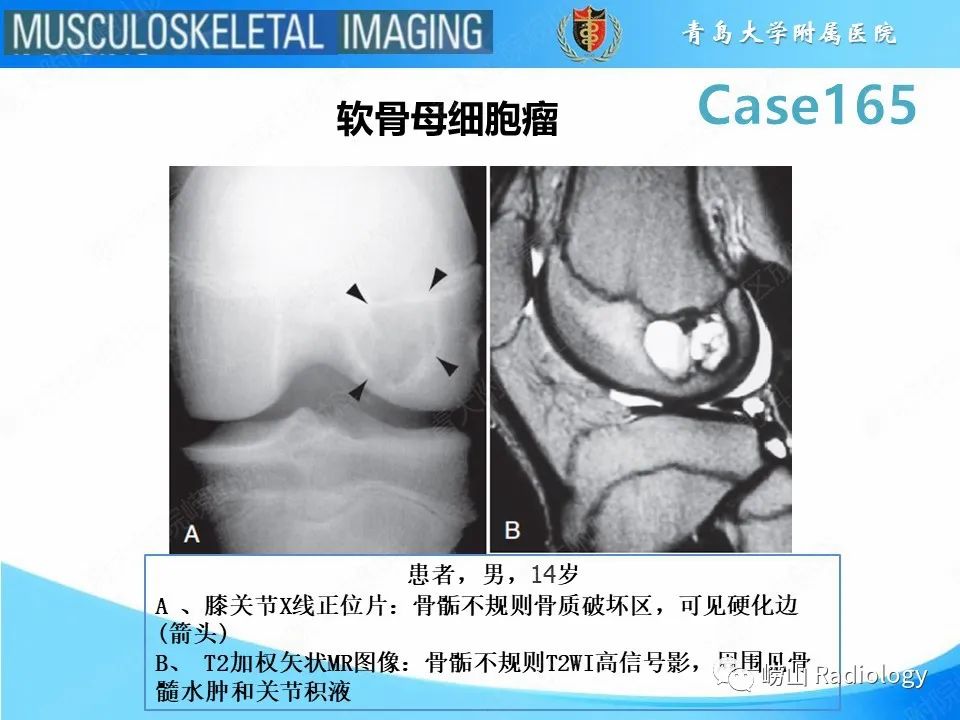 影像PPT - 【PPT】非骨化性纤维瘤-12