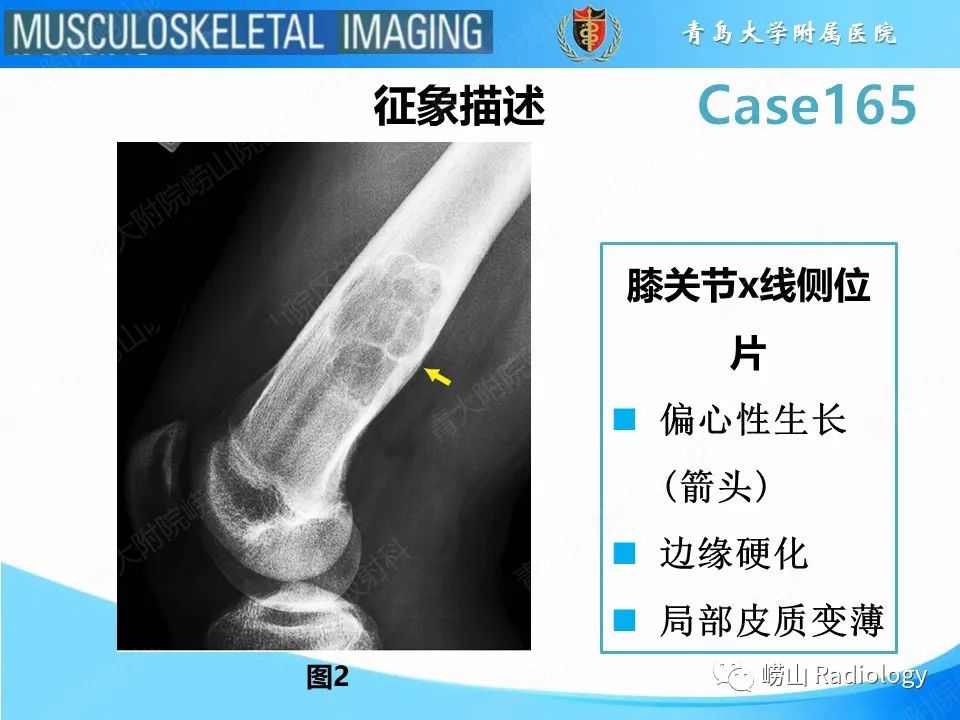 影像PPT - 【PPT】非骨化性纤维瘤-8